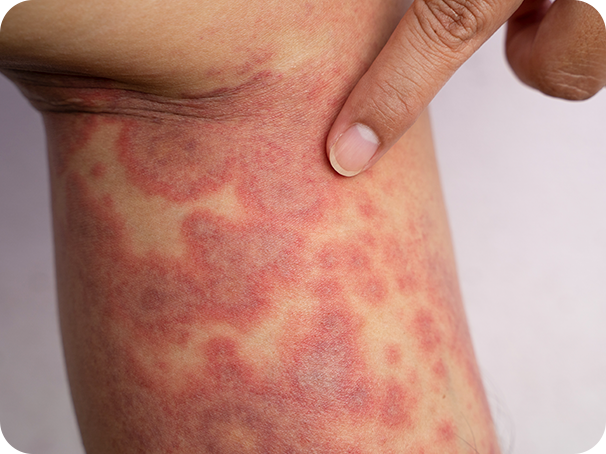 Dermatitis atópica grave3